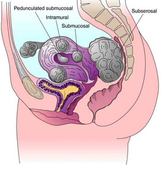 Miomatosis Uterina